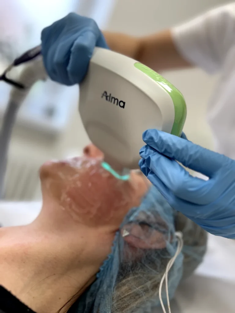 Laser Alma Harmony Gdynia - fototerapia IPL (rumień, przebarwienia)