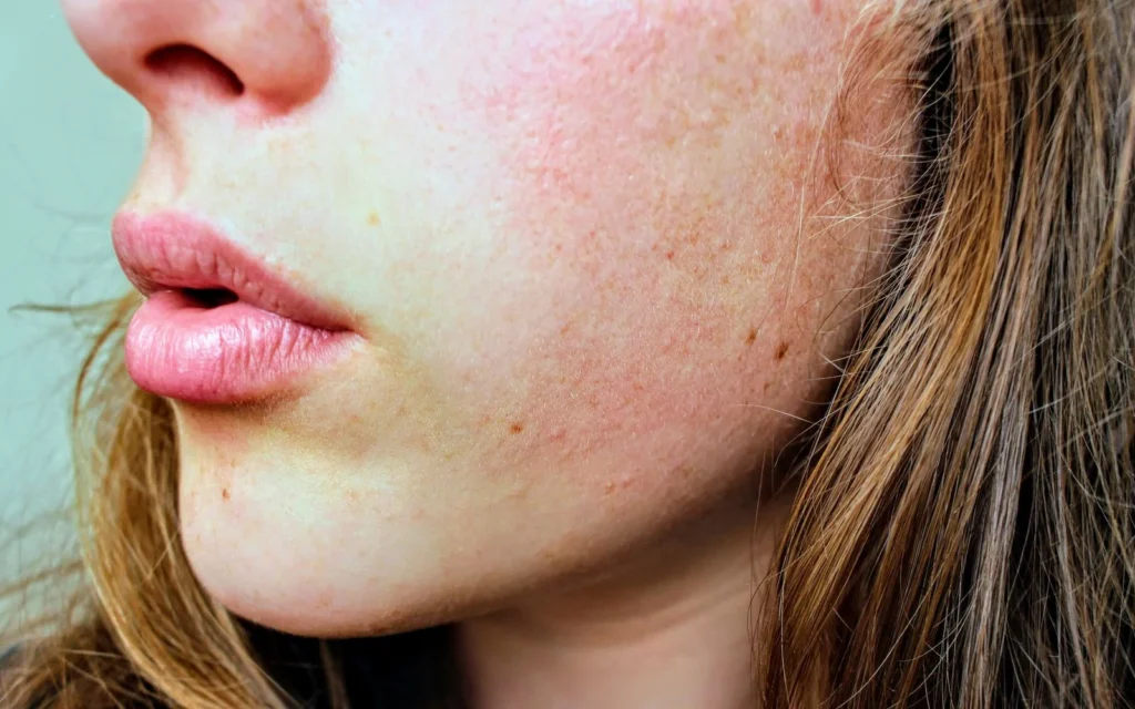 Rumień, rozszerzone naczynka czy trądzik różowaty? Co może poprawić IPL, a kiedy potrzebny jest dermatolog