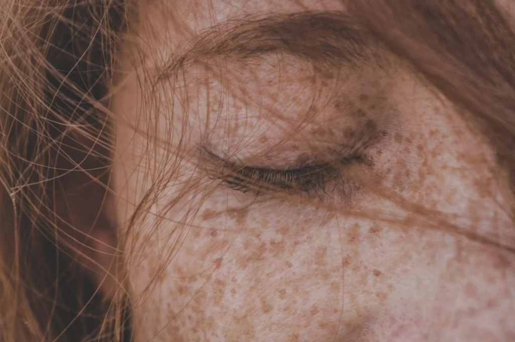 Melasma czy plama posłoneczna? Dlaczego nie każde przebarwienie powinno być od razu traktowane światłem